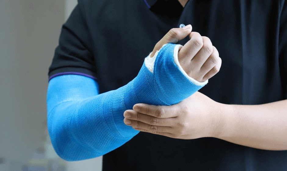 Man with broken arm in a blue cast